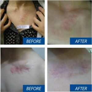 Tratamiento con Dermapen : marcas de quemaduras