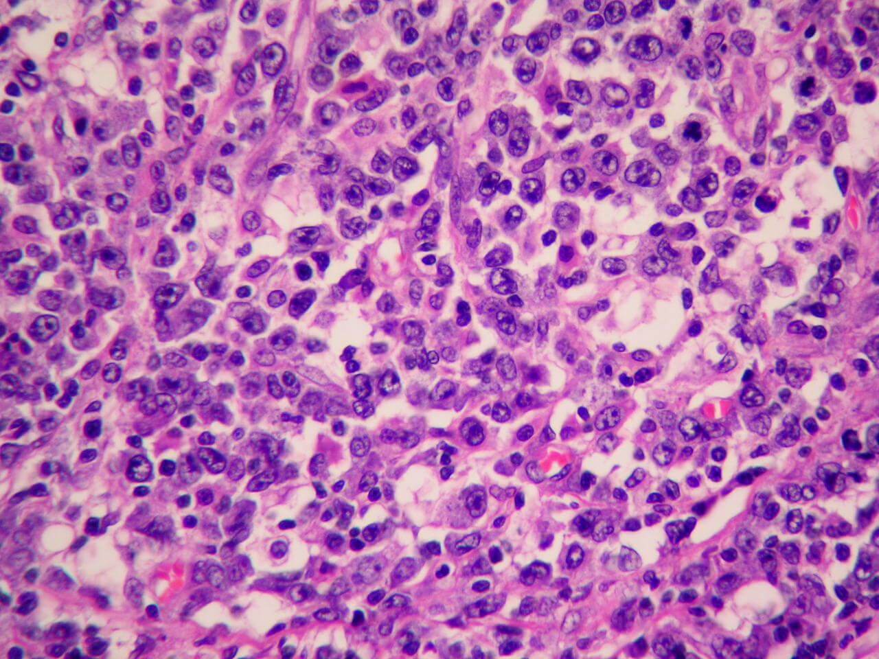 Linfoma anaplásico de células grandes
