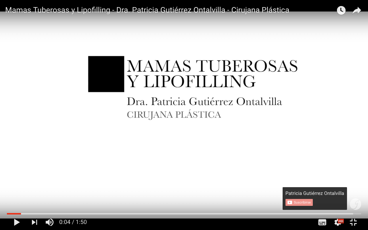 Tratamiento de las Mamas Tuberosas mediante Lipofilling - Dra. Patricia Gutiérrez (cirujana plástica)