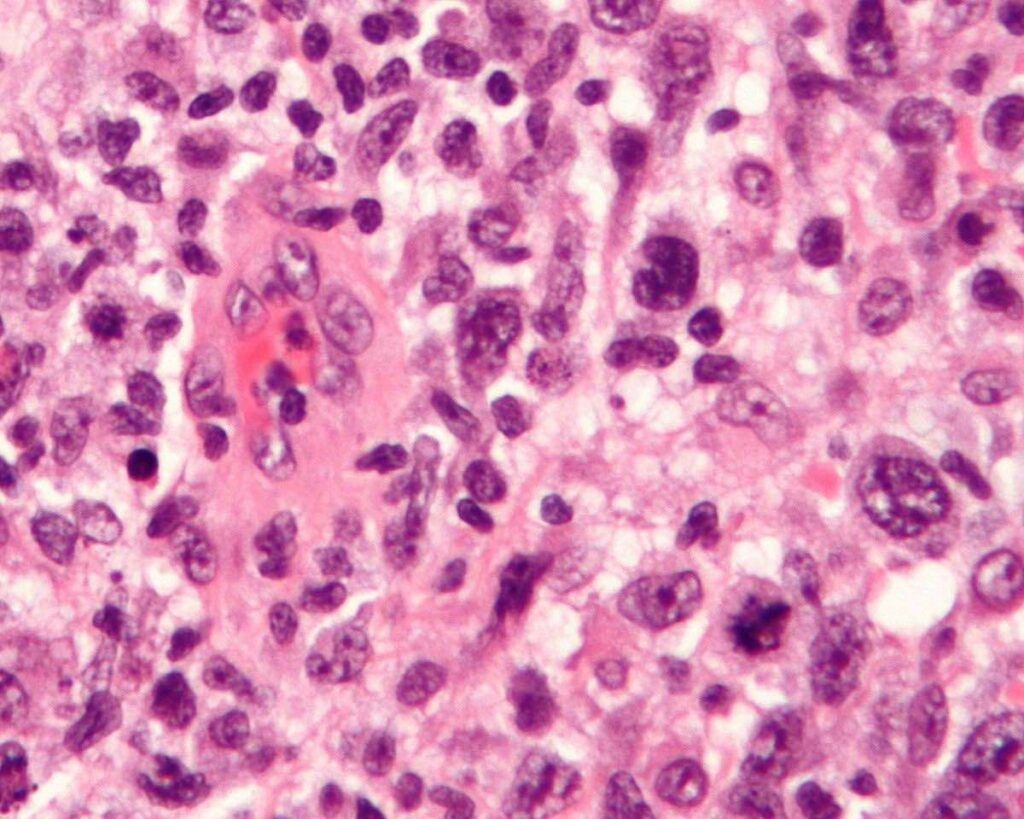 ¿Qué es el Linfoma Anaplásico de Células Grandes (LACG) asociado a implante mamario?