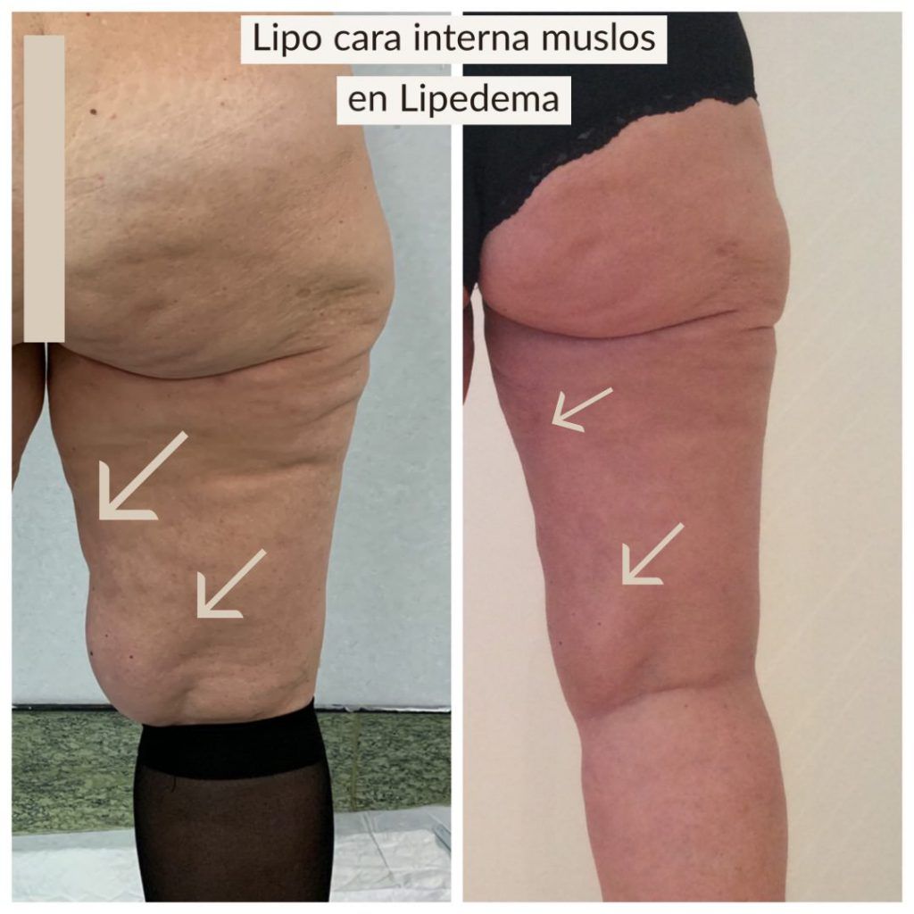 Liposucción en zona interna de los muslos en Lipedema (sólo 2 meses post-cirugía)