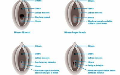 Himenoplastia: reconstrucción del himen con cirugía